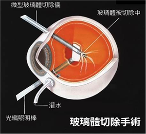 玻璃體視網(wǎng)膜