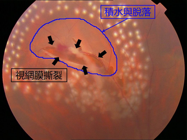 玻璃體視網膜