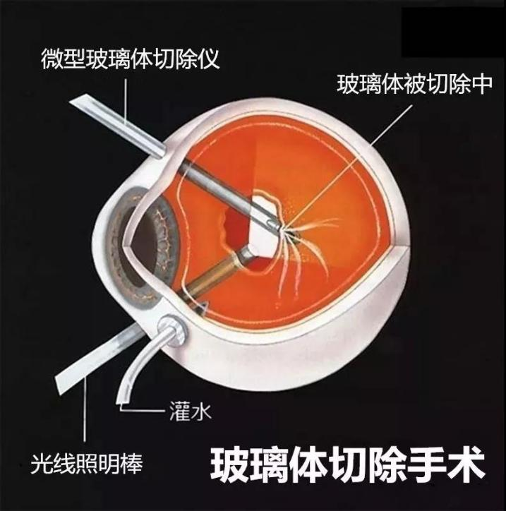 玻璃體視網膜