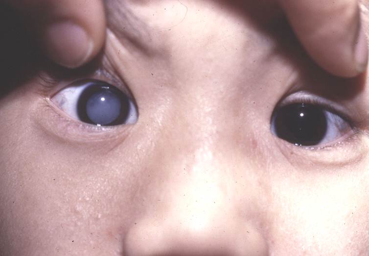 小兒眼病