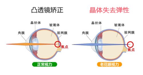 屈光矯視